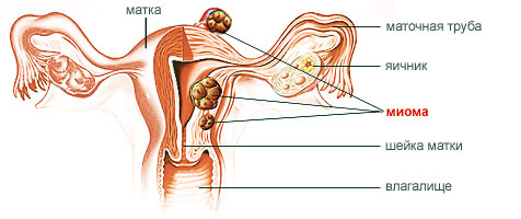 Миома матки
